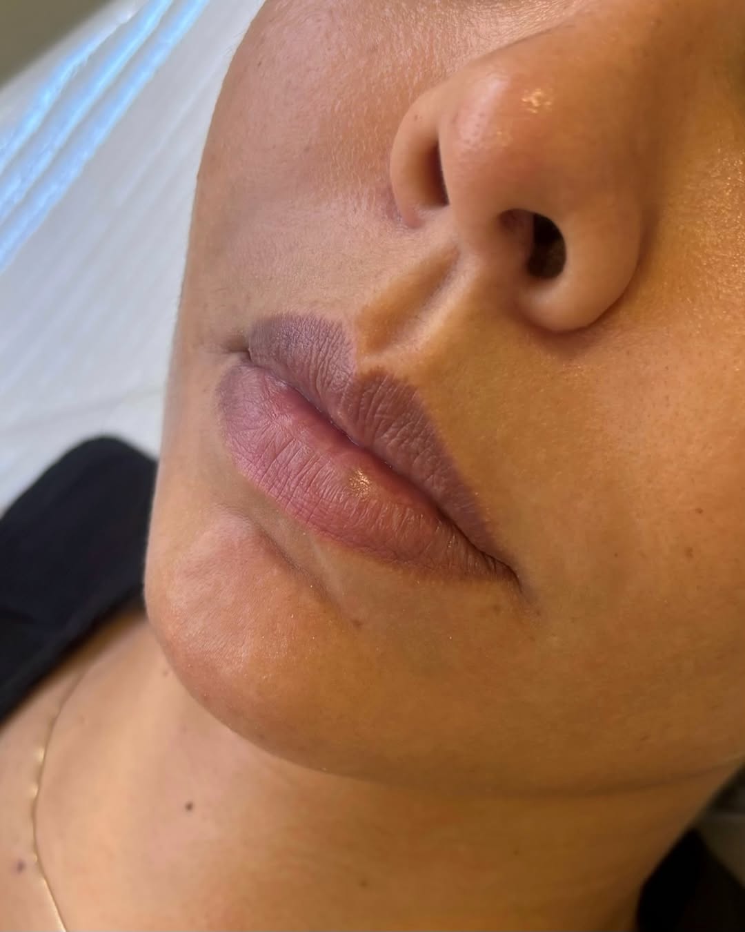 Preenchimento Labial — Antes